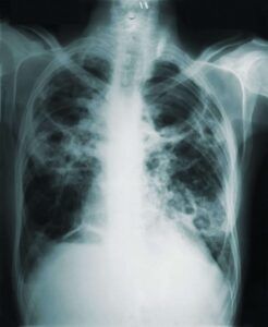 Infecciones pulmonares | MITLAB
